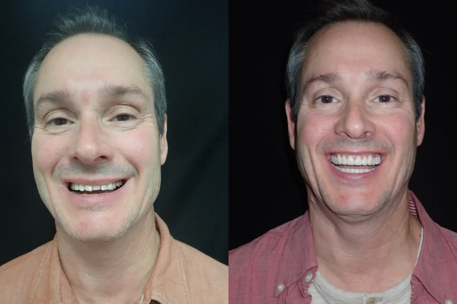 Zirconia dental crowns at Perfect Smile Dental in Tijuana