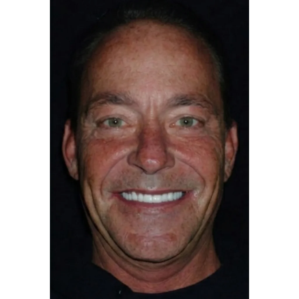 The same patient with their zirconia crowns