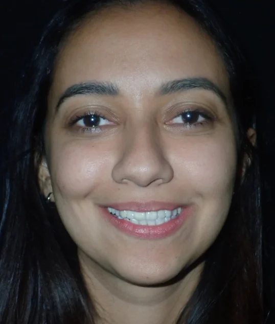 The same patient with their zirconia crowns