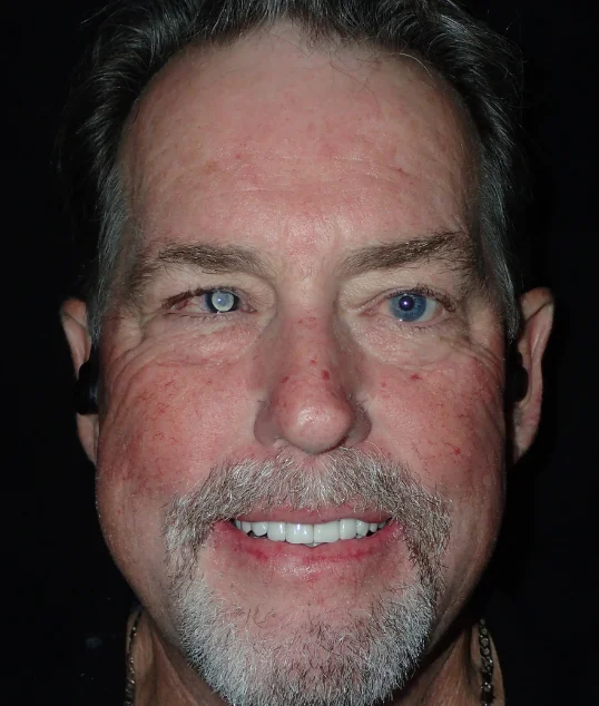 The same patient with their zirconia crowns