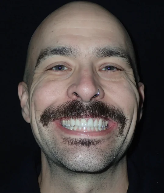 The same patient with their zirconia crowns