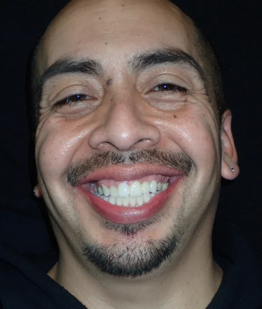 The same patient with their zirconia crowns