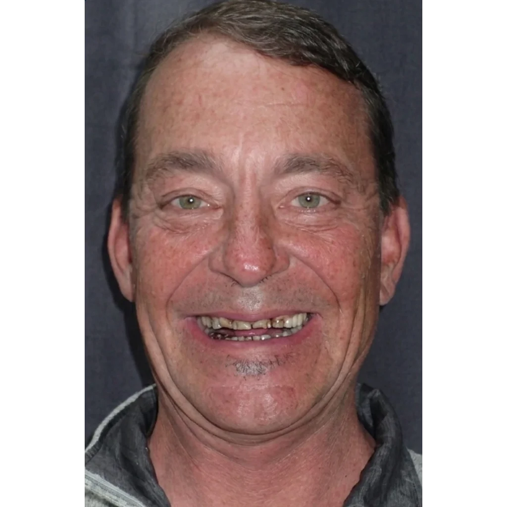 Patient before their zirconia crowns