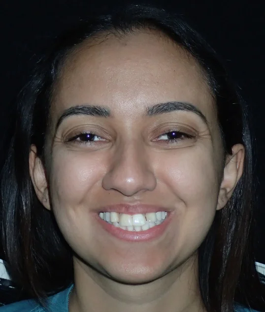 Patient before their zirconia crowns