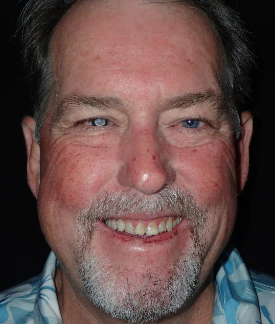 Patient before their zirconia crowns