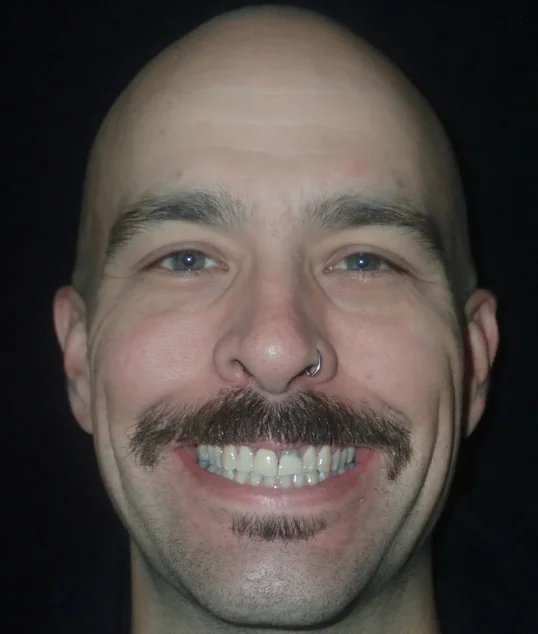 Patient before their zirconia crowns
