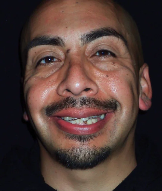 Patient before their zirconia crowns